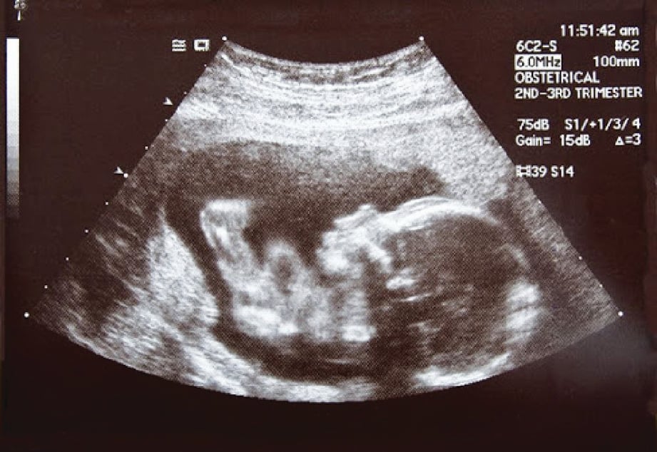 AIR ketuban dikesan menggunakan mesin ultrasound dengan mengira jumlah ‘amniotic fluid index’ (AFI).