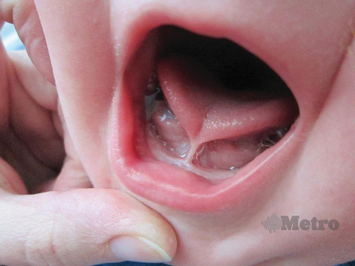 MASALAH lidah pendek boleh dikesan dengan hanya pemeriksaan fizikal yang mudah. 