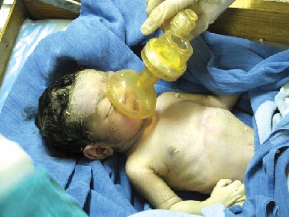 SINDROM aspirasi meconium membabitkan gangguan kepada sistem pernafasan bayi yang tertelan meconium dalam proses kelahiran.