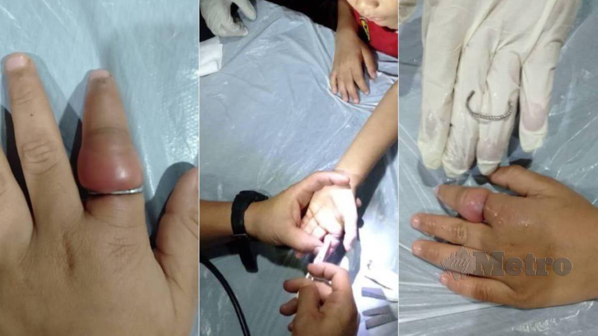 PASUKAN bomba berjaya menanggalkan cincin yang tersangkut pada jari kanak-kanak lelaki. FOTO Ihsan Bomba