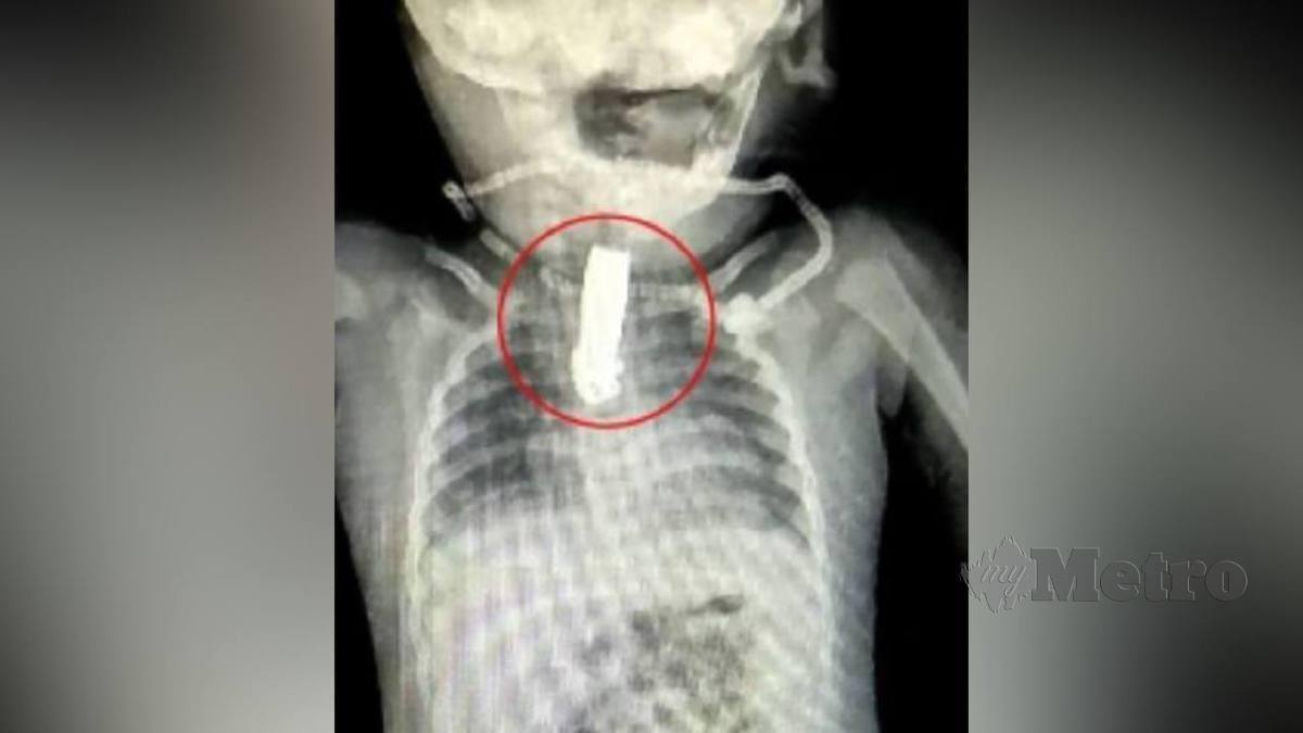 Imbasan sinar X menunjukkan pemotong kuku tersekat pada tekak bayi. FOTO Agensi 