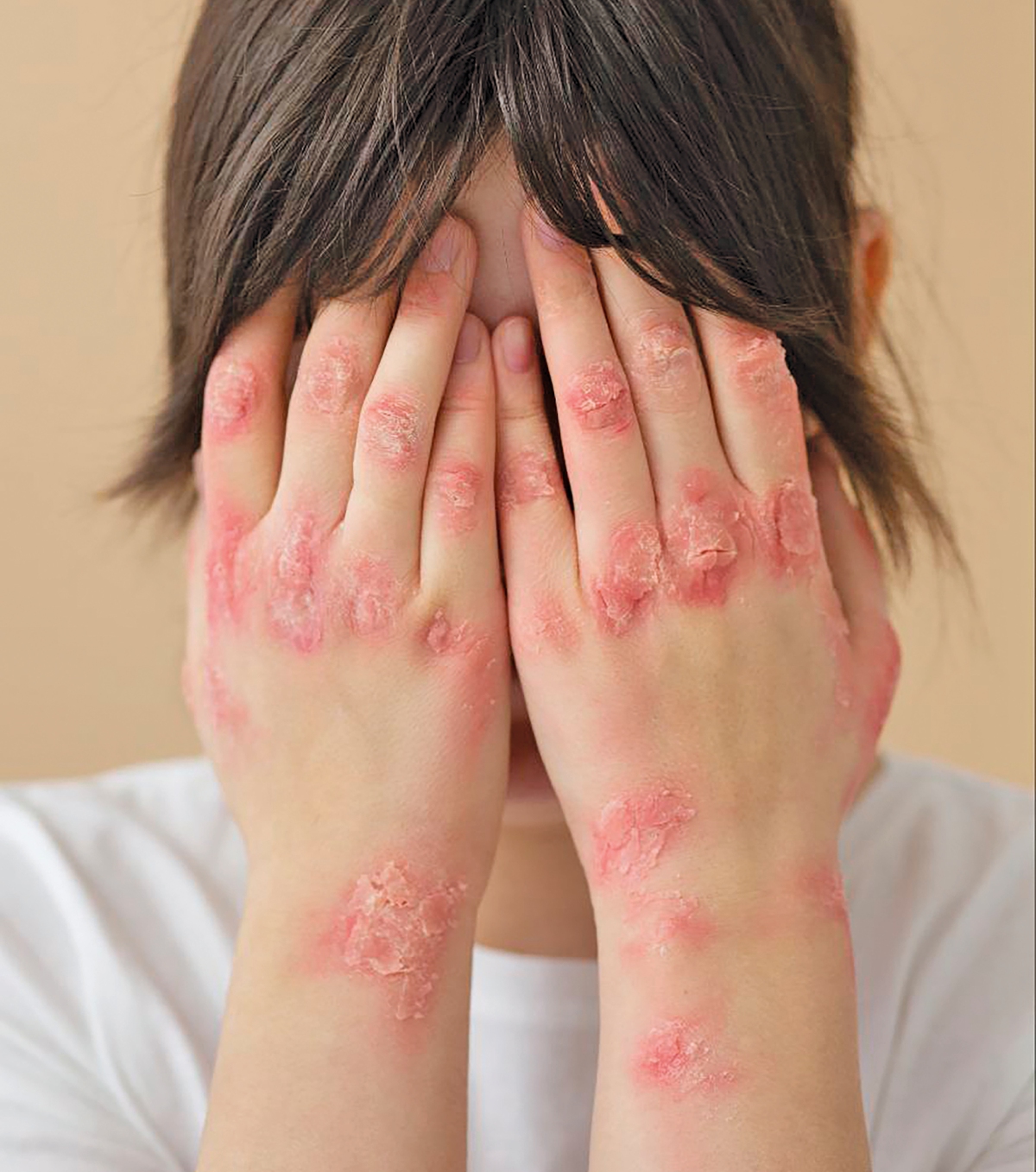 EKZEMA berlaku apabila penghalang kulit rosak dan lemah.