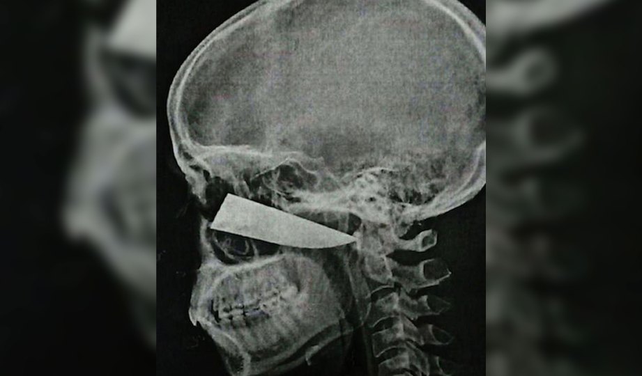 GAMBAR imbasan X-ray menunjukkan kedudukan bilah pisau yang tertanam di muka lelaki berkenaan. FOTO BMJ Case Reports