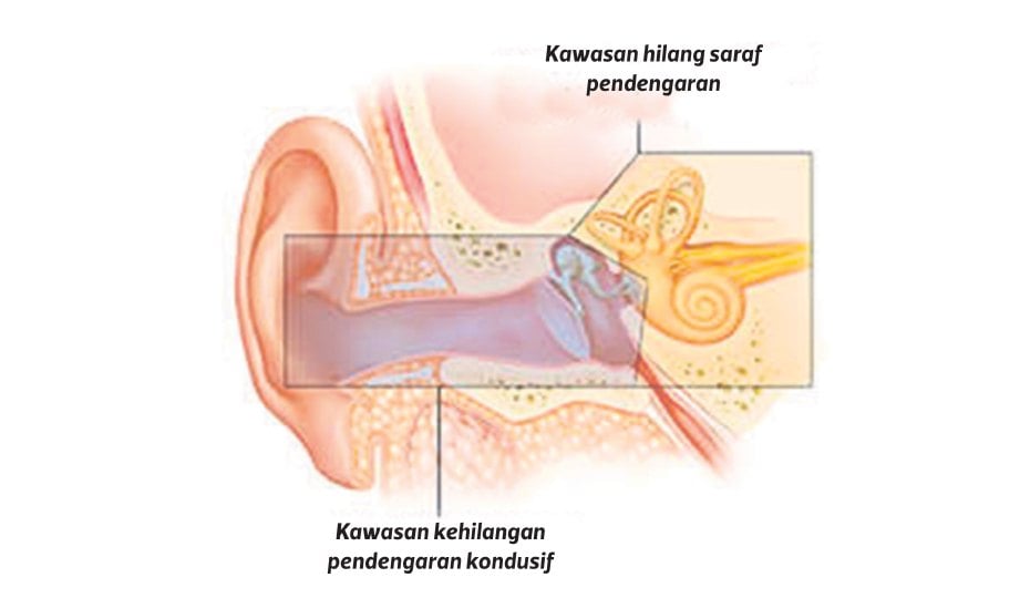 MASALAH pendengaran di kawasan konduktif atau telinga luar dan sensorineural.