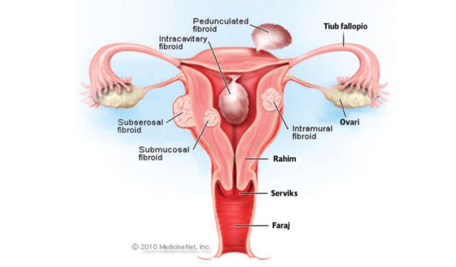 FIBROID dalam rahim.