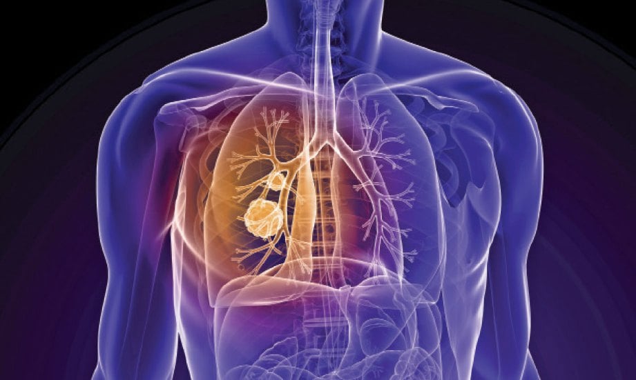 PULMONARI tersumbat kronik (COPD) muncul secara perlahan-lahan, semakin ketara apabila penghidap berusia 40 hingga 50 tahun.