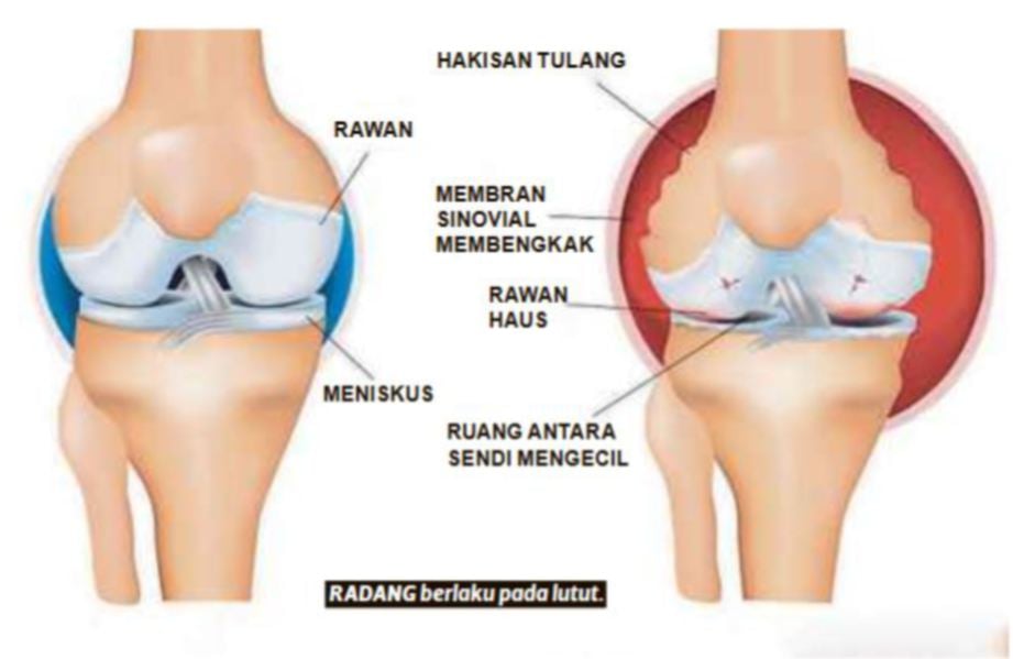 RADANG berlaku pada lutut.  