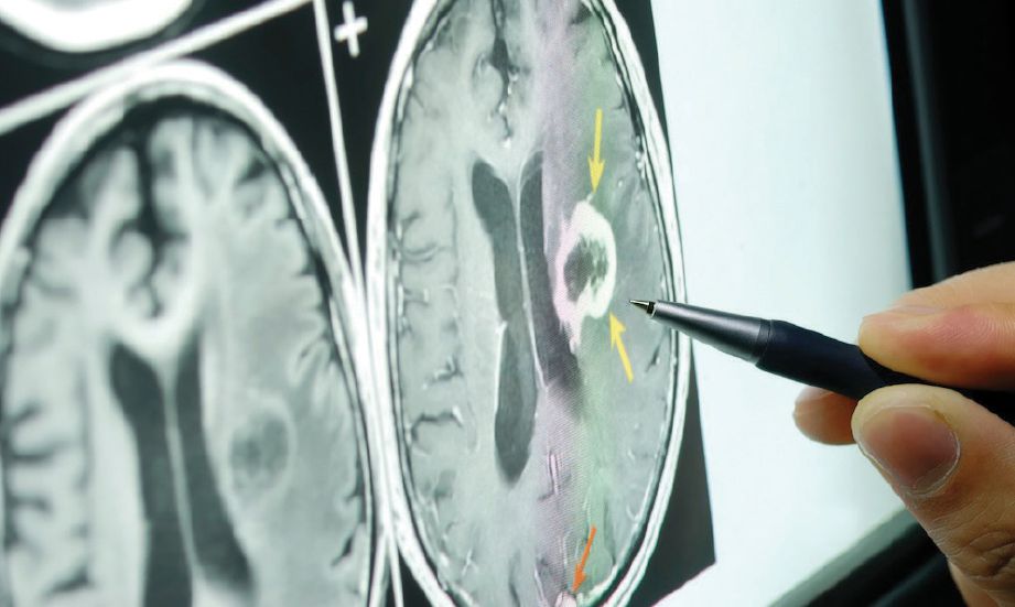 SEL kanser di bahagian otak dikesan sebelum rawatan dijalankan.