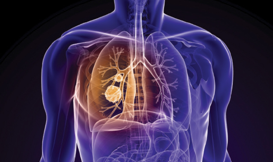 PENDEDAHAN berpanjangan kepada jelaga rosakkan paru-paru dan saluran udara, terutama paip, cerut, asap tembakau.