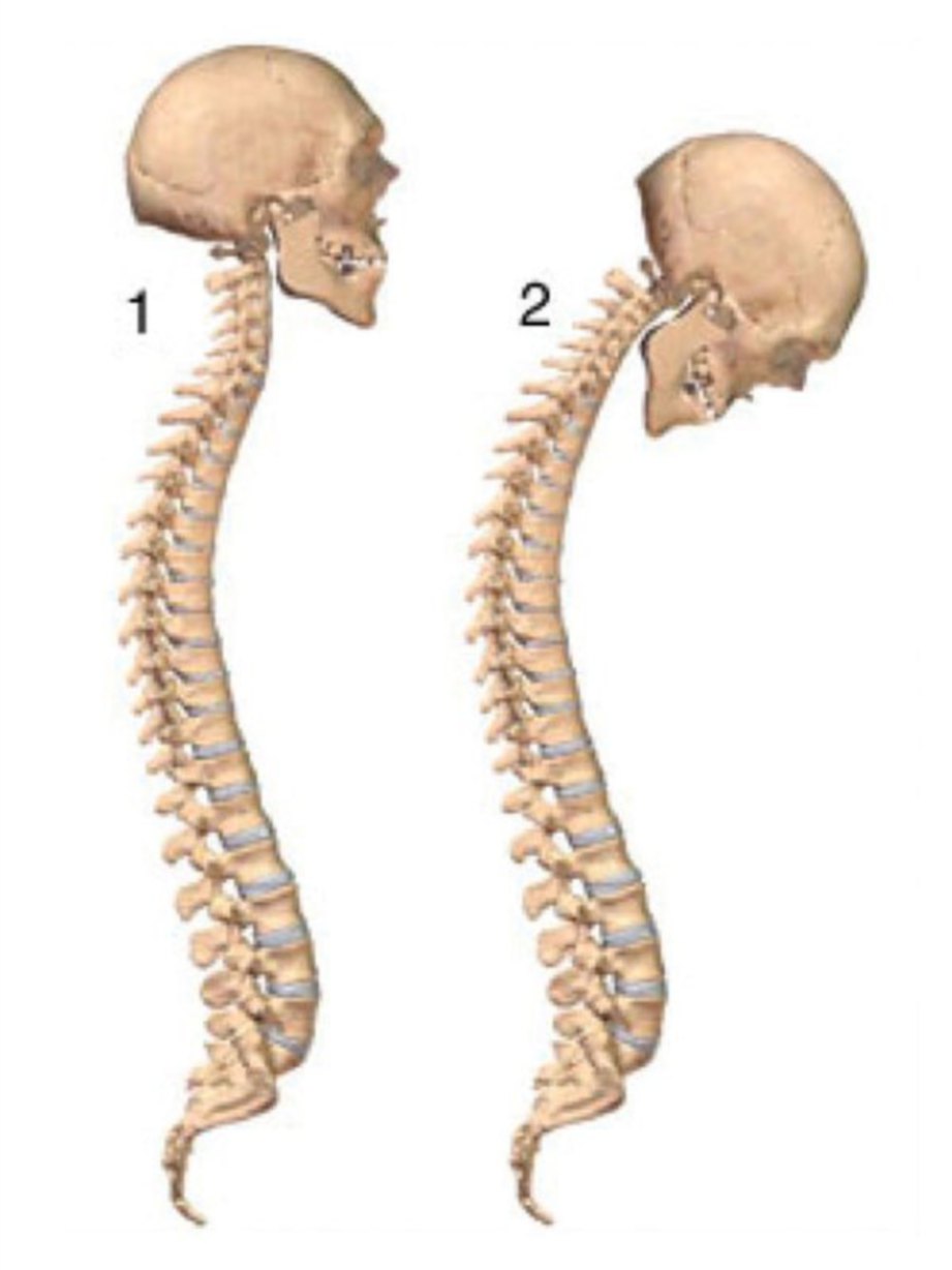 PERBEZAAN tulang belakang normal (gambar 1) dengan tulang bermasalah.