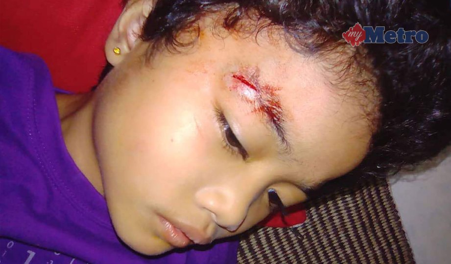 LUKA dialami Qurratul Aini Maisara selepas terjatuh apabila diserang sawan. FOTO NSTP