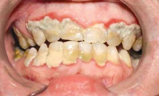 SKURVI menyebabkan gigi rosak.
