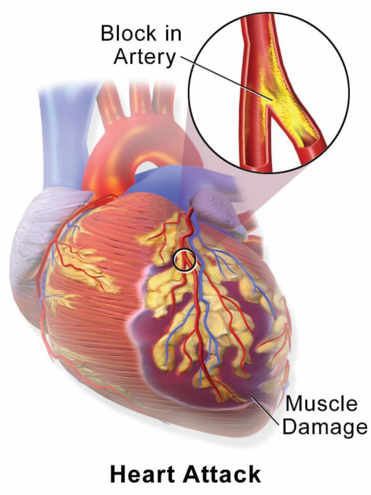 SALUR darah jantung (salur darah koronari) yang tersumbat dan berlaku secara tiba-tiba menyebabkan serangan jantung. 