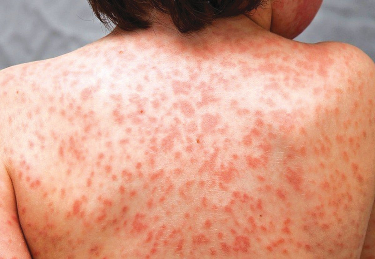 GEJALA penyakit Kawasaki menimbulkan ruam merah pada badan. - FOTO Google