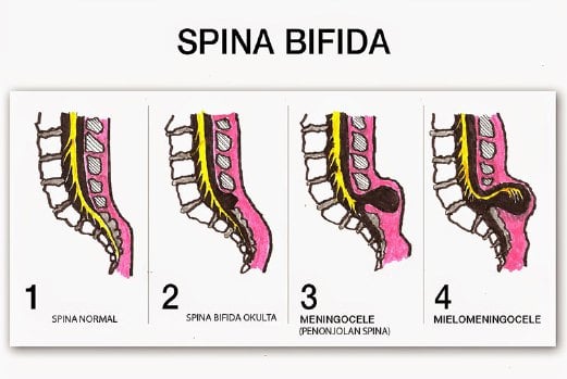 Jenis Spina Bifida Dan Penyebabnya Wecare Id My Xxx Hot Girl 7831