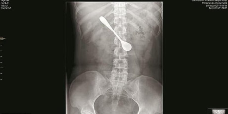IMEJ X-ray menunjukkan sudu besi dalam usus Lili.