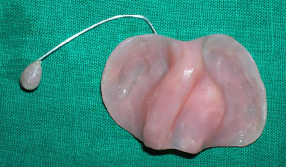 FEEDING plate digunakan untuk bayi sumbing makan sebelum pembedahan dilakukan.
