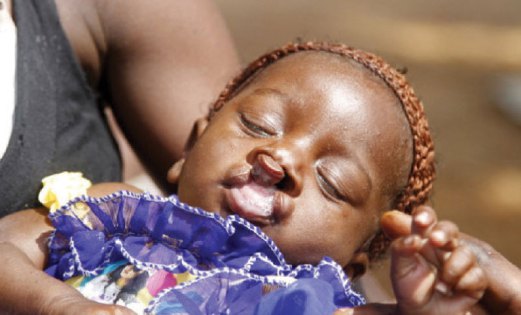 RAMAI kanak-kanak Afrika Barat yang sumbing bibir dan lelangit tidak mendapat rawatan.