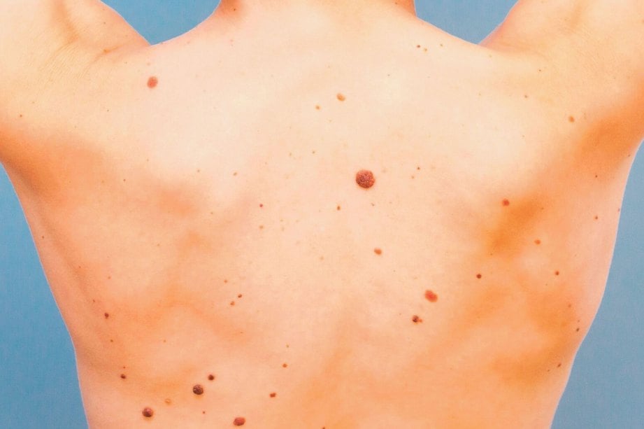 PENGESANAN atau pemeriksaan tahi lalat penting bagi mencegah penyakit kanser kulit.