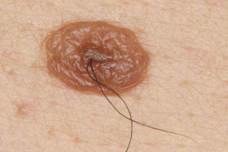 TAHI lalat berdarah berisiko berubah menjadi kanser kulit.