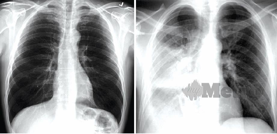 GAMBAR kiri, paru-paru normal dan gambar kanan imbasan paru-paru dijangkiti kuman tibi.