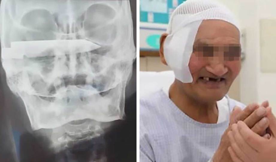 GAMBAR X-ray pisau yang tertanam di tengkorak. Gambar kanan, Duorijie terselamat selepas pembedahan membuang pisau dalam kepalanya. FOTO Oddity Central