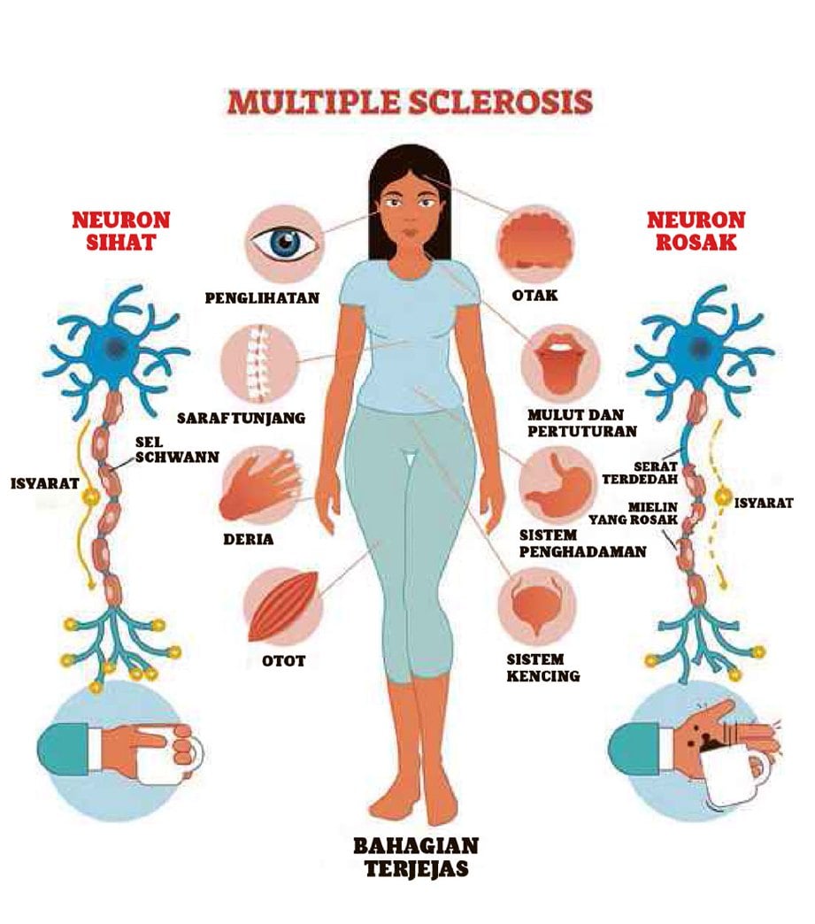 Penyakit multiple sclerosis