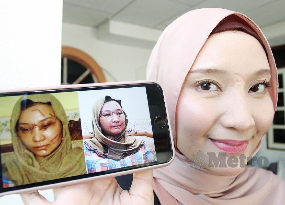 KESAN parut di wajah Nur Syafiqa masih kelihatan. FOTO Nik Abdullah Nik Omar