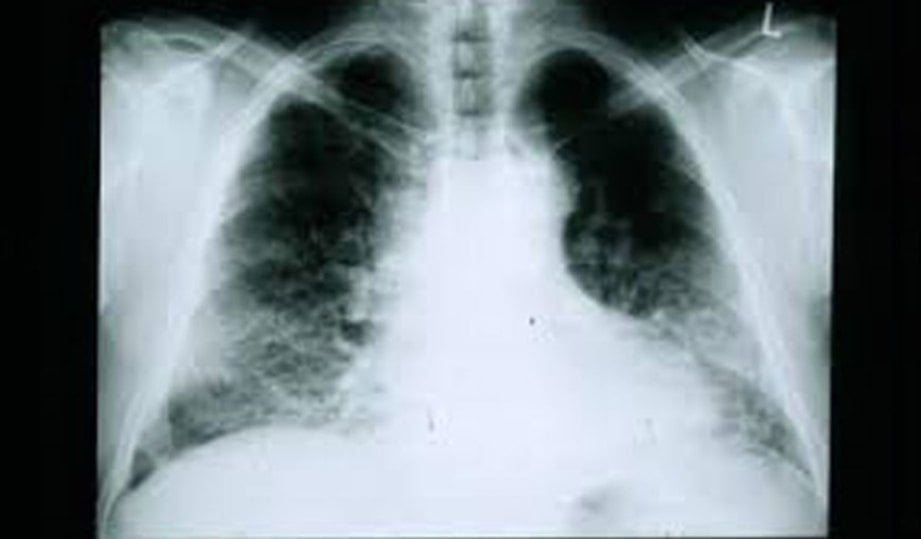 BAHAGIAN paru-paru yang menghadapi masalah.