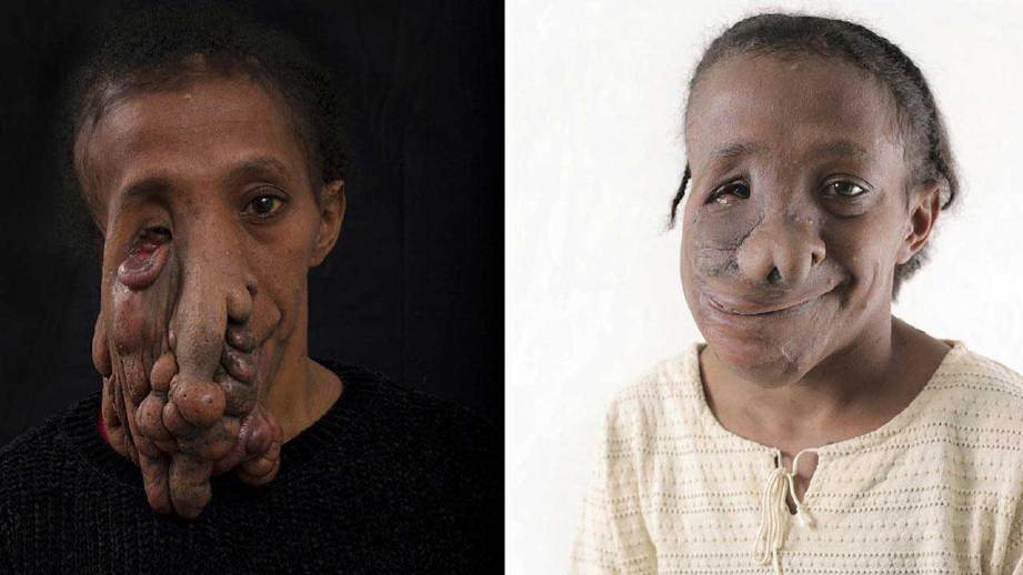 GAMBAR kiri, wajah asal Natalia yang dipenuhi ketumbuhan, manakala kanan selepas menjalani pembedahan membuang ketumbuhan dan membentuk semula wajahnya. FOTO Luke Fuda /South Western Sydney Local Health District