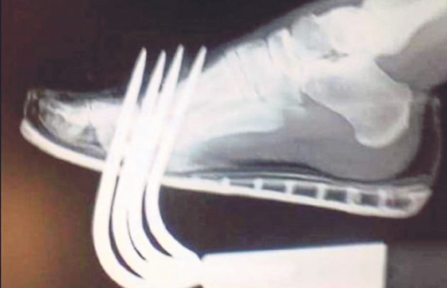 IMBASAN X-ray menunjukkan bagaimana pencakar itu menusuk kaki pesakit. - Daily Mail 