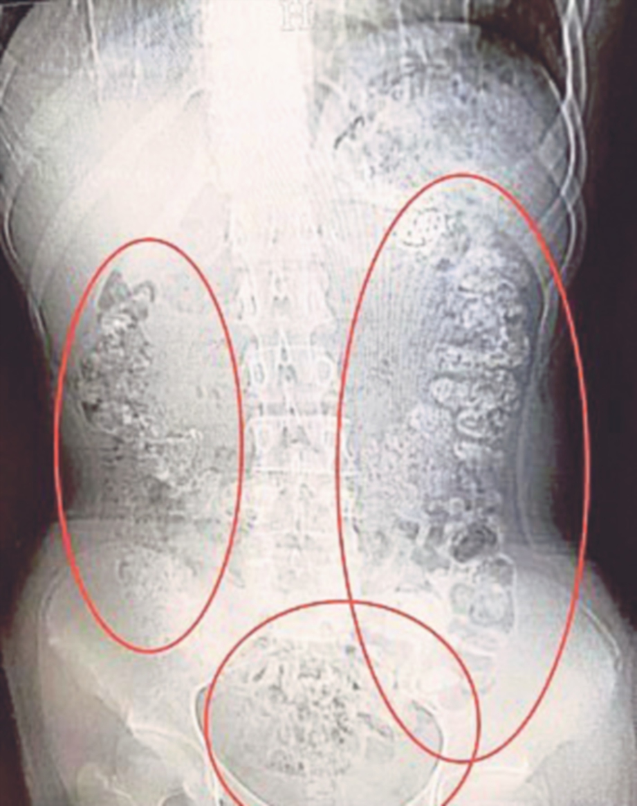 GAMBAR imbasan X-ray menunjukkan bebola ubi yang tersumbat di dalam usus remaja itu. FOTO Agensi