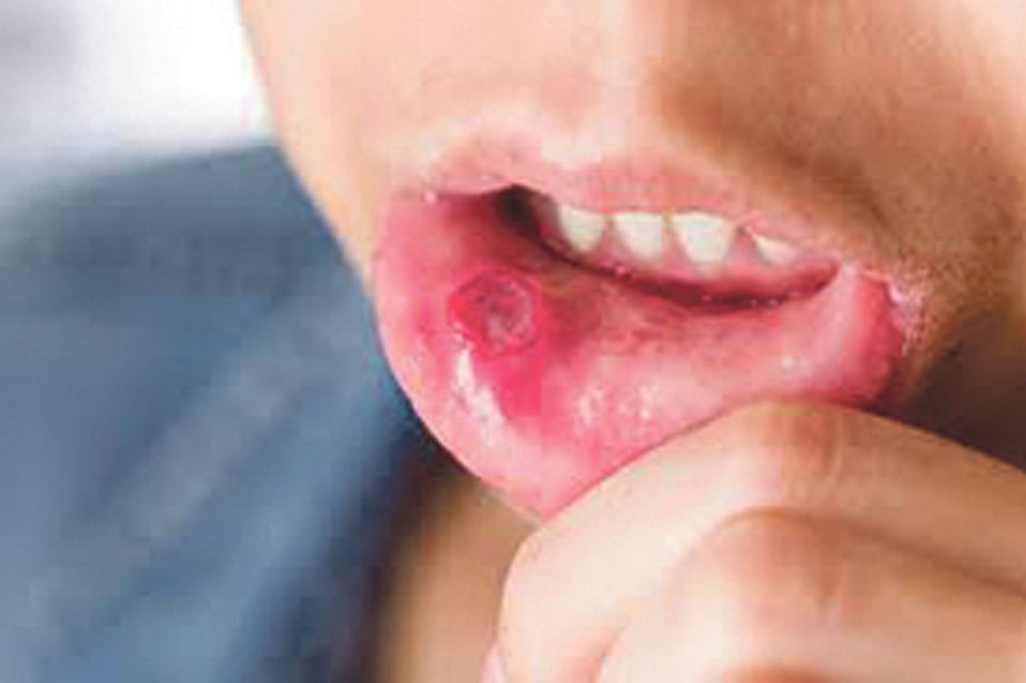 Cara hilangkan ulser mulut