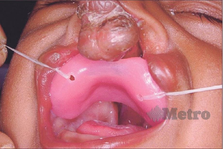 BUNYI terhasil menerusi hidung mungkin tanda mulut sumbing yang boleh dirawat sejak lahir.
