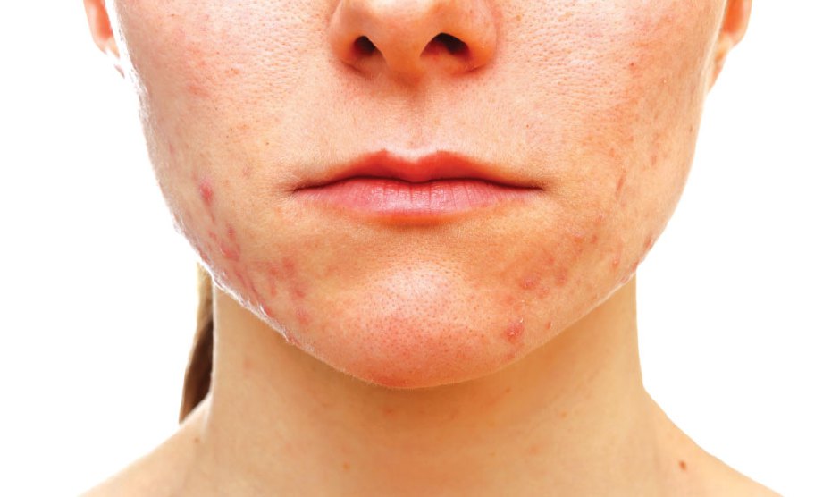 PCOS boleh menyebabkan wanita mengalami masalah kulit seperti lelaki disebabkan hormon lelaki yang berlebihan.