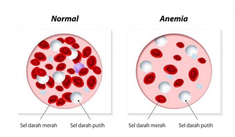 Risiko anemia ketika hamil